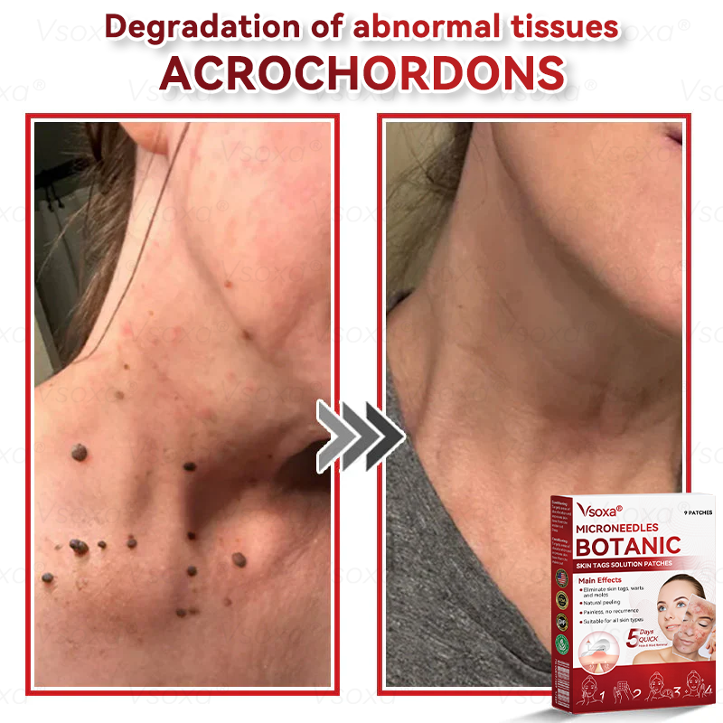 𝑉𝑠𝑜𝑥𝑎® 💧Microneedles Botanical Skin Tags Solution Patches - Made in the USA👩‍⚕️