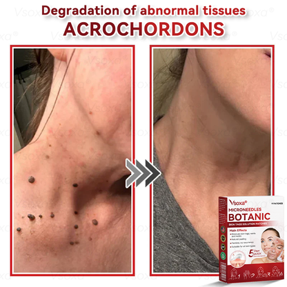 𝑉𝑠𝑜𝑥𝑎® 💧Microneedles Botanical Skin Tags Solution Patches - Made in the USA👩‍⚕️