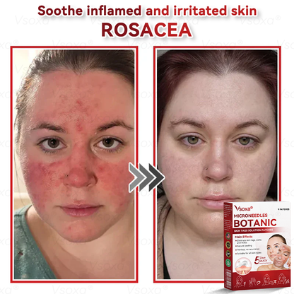 𝑉𝑠𝑜𝑥𝑎® 💧Microneedles Botanical Skin Tags Solution Patches - Made in the USA👩‍⚕️