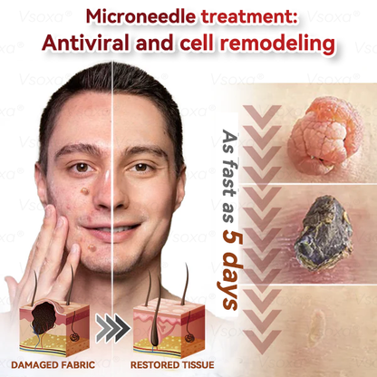 𝑉𝑠𝑜𝑥𝑎® 💧Microneedles Botanical Skin Tags Solution Patches - Made in the USA👩‍⚕️